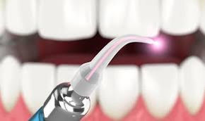 Laser dentist Chandigarh, top laser dentist Chandigarh, best laser dentist Chandigarh  
