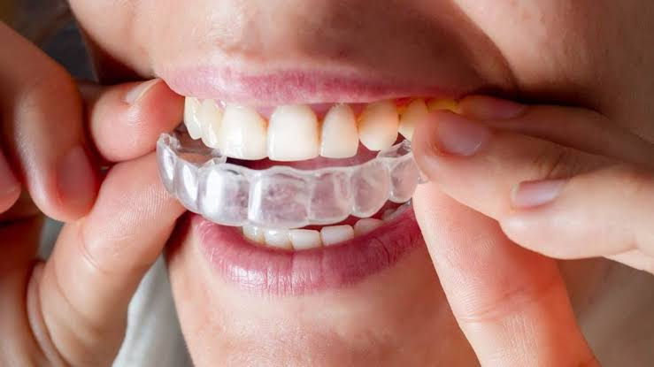 Invisalign chandigarh, cost of invisalign chandigarh , best dentist invisalign Chandigarh