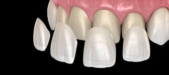 Best veneer specialist Punjab, Best veneers at affordable prices Punjab, Best veneers at best prices Punjab ,