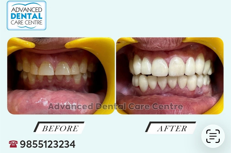 Real-time before and after image showing worn-down and short teeth due to attrition restored with porcelain veneers at Advanced Dental Care Center Chandigarh.