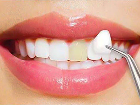 CHANDIGARH DENTAL VENEERS - PORCELAIN VENEERS TREATMENT FOR TEETH FLUOROSIS | FLUORIDE STAINING