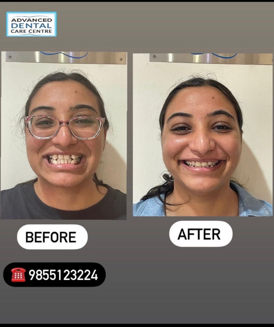 Real-time before and after image of smile makeover showing crooked teeth corrected with porcelain veneers at Advanced Dental Care Center Chandigarh.