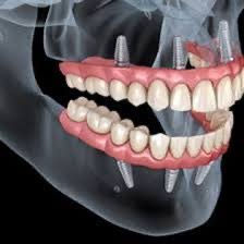 Best implant dentist in Chandigarh