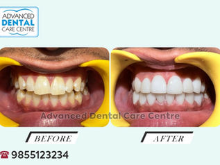 Porcelain Veneers for teeth Fluorosis in India : Best Treatment for Discolored Teeth | Advanced Dental Care Center , Chandigarh