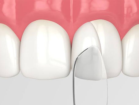 Dental bonding cost in Chandigarh