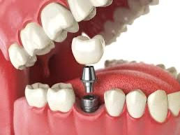 Exploring the best cost of dental implants in India in 2025