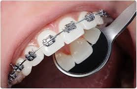Braces in chandigarh, Cost of braces chandigarh , Best braces dentist chandigarh, Best orthodontist chandigarh, metal braces chandigarh, teeth braces cost Chandigarh