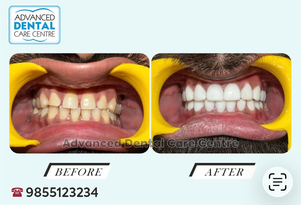 Real-time before and after dental implant case showing missing teeth replaced with fixed implant-supported teeth at Advanced Dental Care Center Chandigarh.