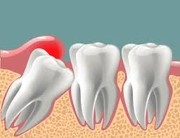 Lower wisdom tooth removal in Chandigarh 