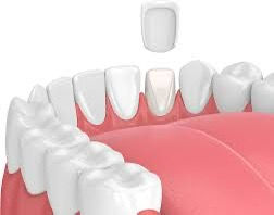 Digital Veneers in Chandigarh