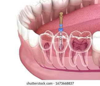 HOW TO FIND THE BEST ROOT CANAL TREATMENT DOCTOR NEAR ME IN MOHALI, INIDA