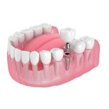 Dental implants in Chandigarh