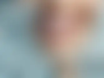 Porcelain Veneers in Chandigarh vs Composite Veneers in Chandigarh: Which Is Better for NRIs