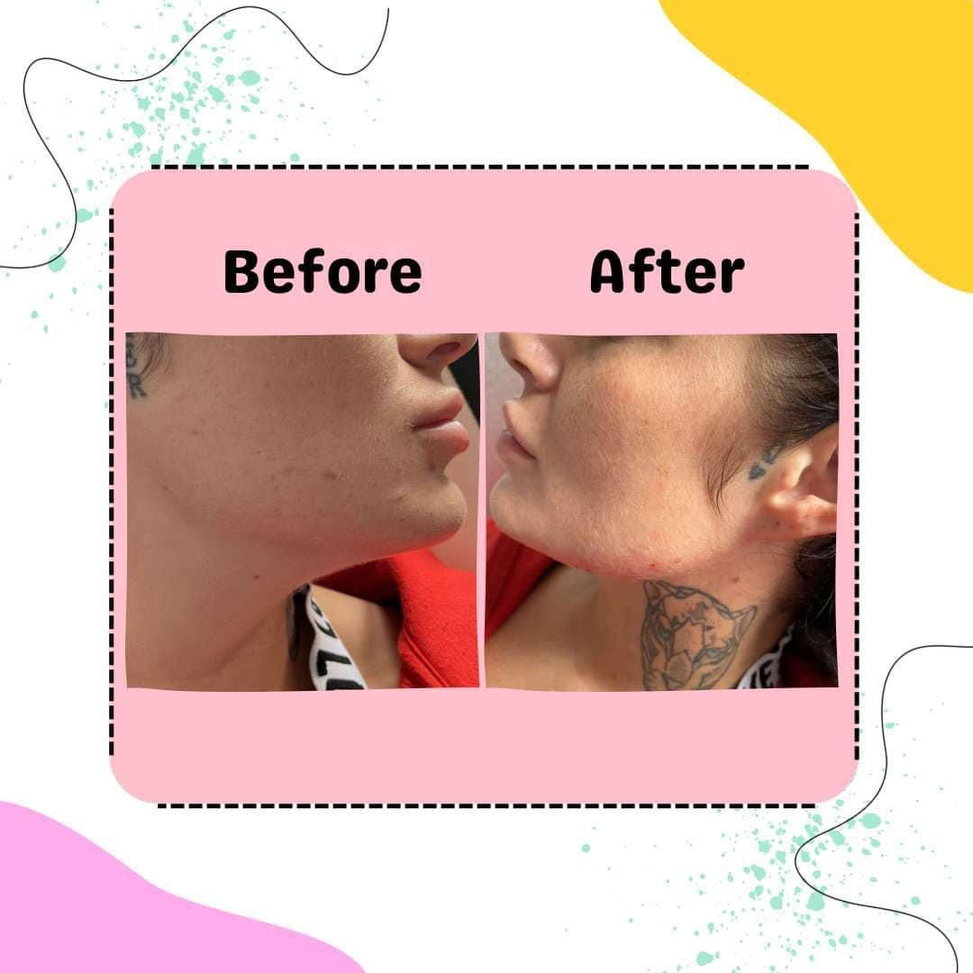Cheek Enhancement 2.2ml Dermal Filler Treatment 