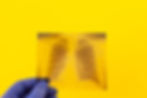Yellow lung x-ray. Radiologists can suffer from long term disability.