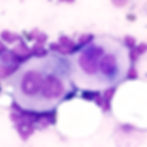 lymphoma can cause physical disability