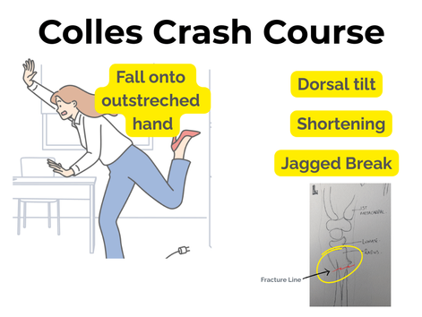 Colles Fracture Made Simple: Exam Essentials