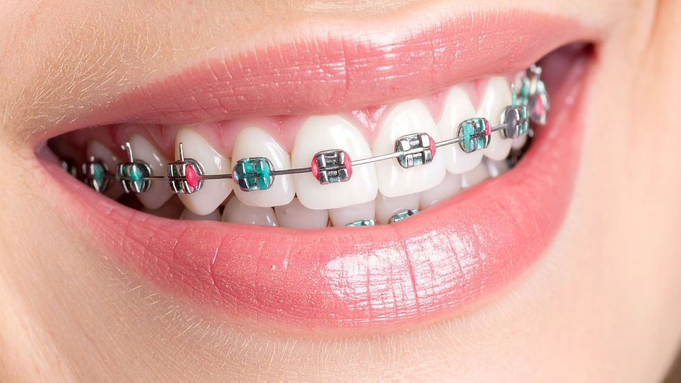 aparat dentar metalic