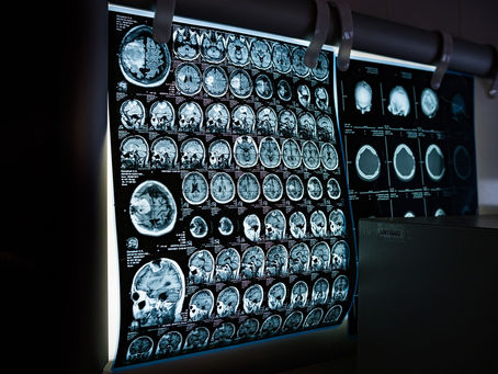 Illuminated brain MRI scans displayed on a lightbox in a medical setting. The images show detailed brain structures in various sections.