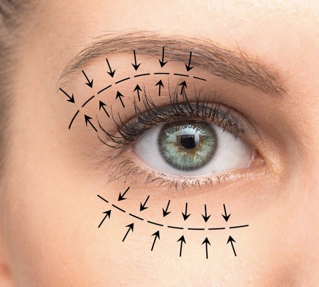 Blefaroplastia - Mapa auricular Jato de plasma.webp