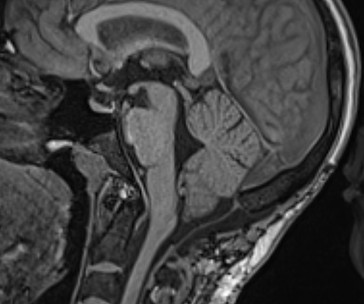 Chiari I 