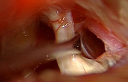microvascular decompression