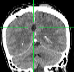 falx cerebri meningioma