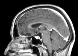 meningioma sag after