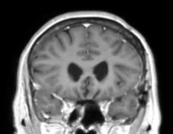 meningioma cor after