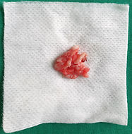 diska trūce | disk prolapse |hernia