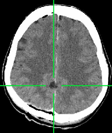 falx cerebri meningioma