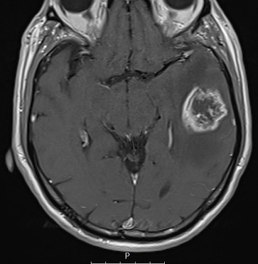 glioblastoma