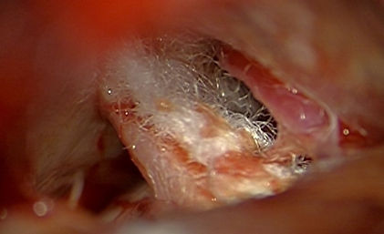 microvascular decompression