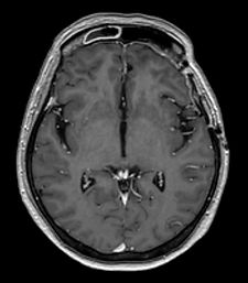 meningioma ax after