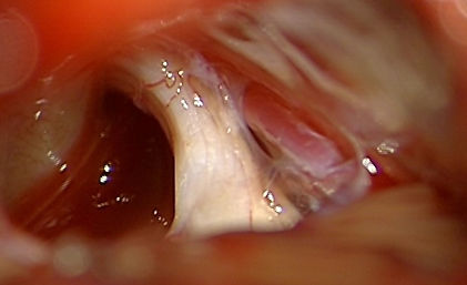 microvascular decompression