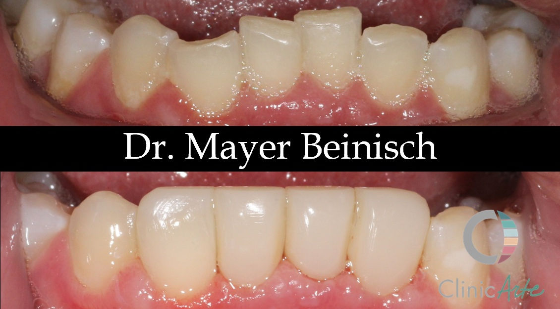 Clinica odontologica de alto padrão em higienópolis, focado em estética oral, implantes, invisalign, limpeza, raspagem emergencia, aparelhos ortodonticos, atendimentos com crianças.
181
High-end dental clinic in Higienópolis, focused on oral aesthetics, implants, Invisalign, cleaning, emergency scaling, orthodontic appliances, and pediatric care.