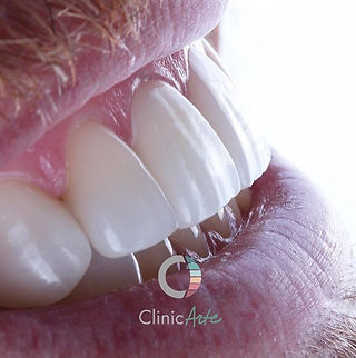 lente de contato dental.