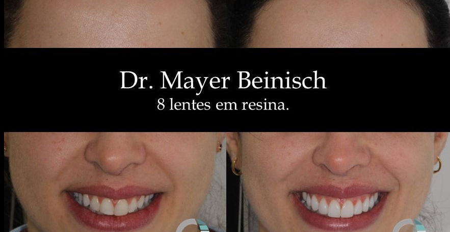 Clinica odontologica de alto padrão em higienópolis, focado em estética oral, implantes, invisalign, limpeza, raspagem emergencia, aparelhos ortodonticos, atendimentos com crianças.
181
High-end dental clinic in Higienópolis, focused on oral aesthetics, implants, Invisalign, cleaning, emergency scaling, orthodontic appliances, and pediatric care.