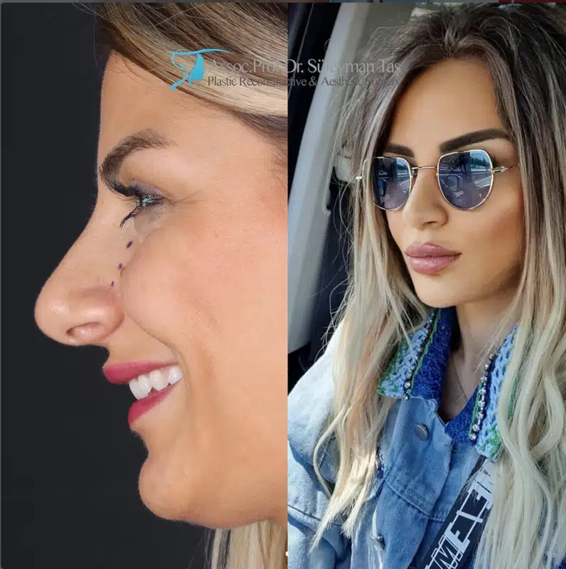 Suleyman Tas reviews – verified rhinoplasty patient review #175 (photo 2)