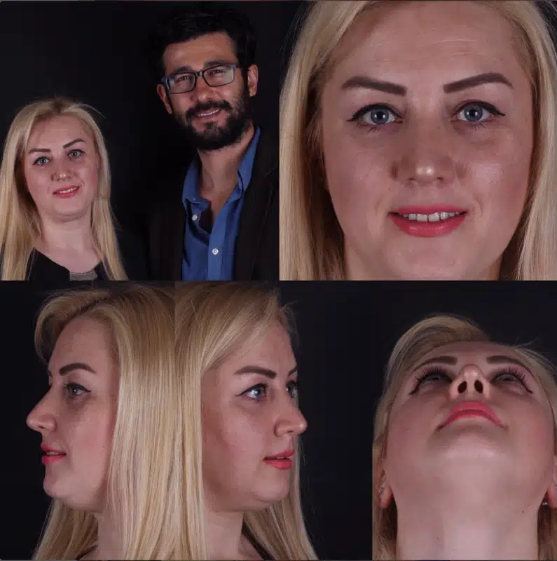 Suleyman Tas reviews – verified rhinoplasty patient review #308