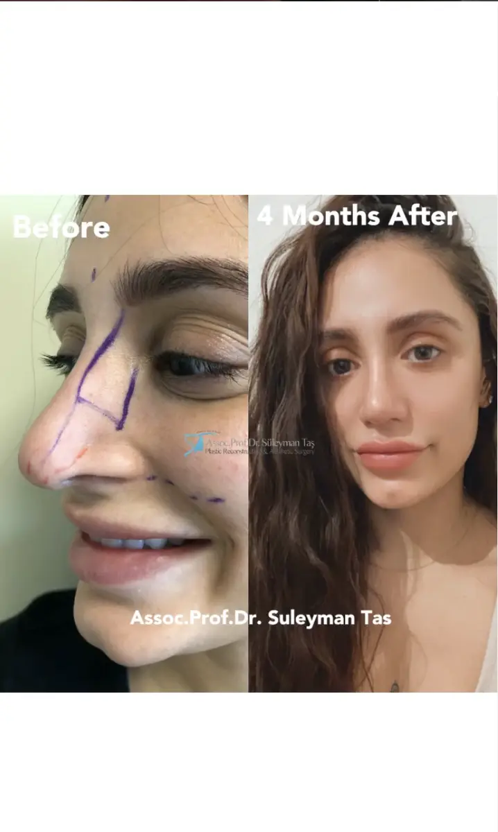 Suleyman Tas reviews – verified rhinoplasty patient review #151 (photo 1)