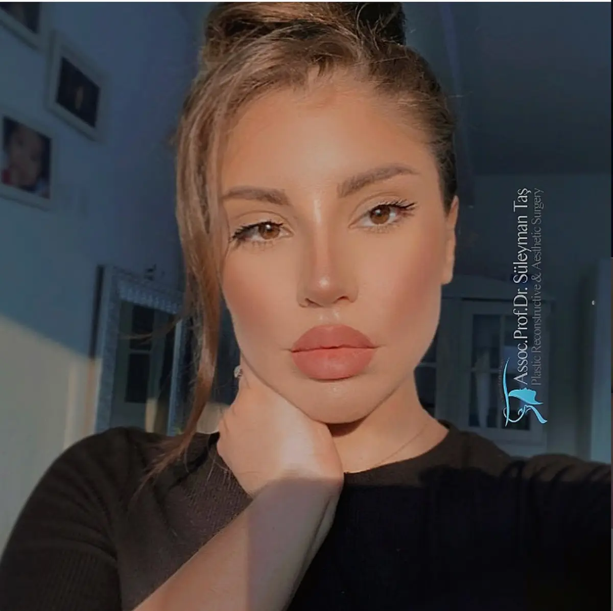 Suleyman Tas reviews – verified rhinoplasty patient review #137 (photo 2)