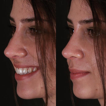 Revision Rhinoplasty before and after photo of a female patient, three-quarter view, by Prof. Dr. Süleyman Taş, plastic surgeon in Istanbul