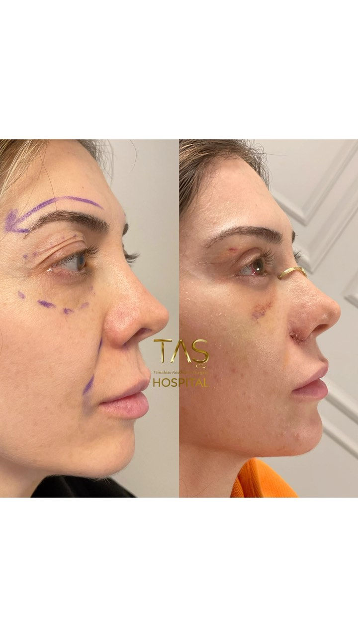 Scarless facelift before and after, patient of Prof. Dr. Suleyman Tas, Istanbul