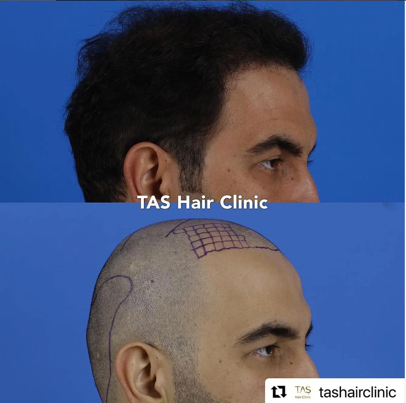 Suleyman Tas reviews – verified hair transplant patient review #56 (photo 1)