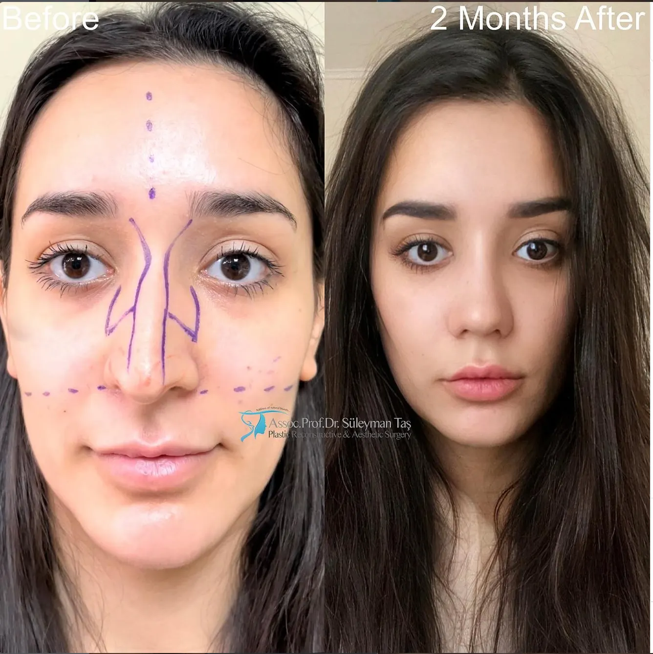 Suleyman Tas reviews – verified rhinoplasty patient review #91 (photo 1)