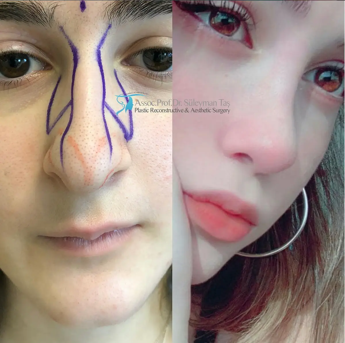 Suleyman Tas reviews – verified rhinoplasty patient review #152 (photo 2)