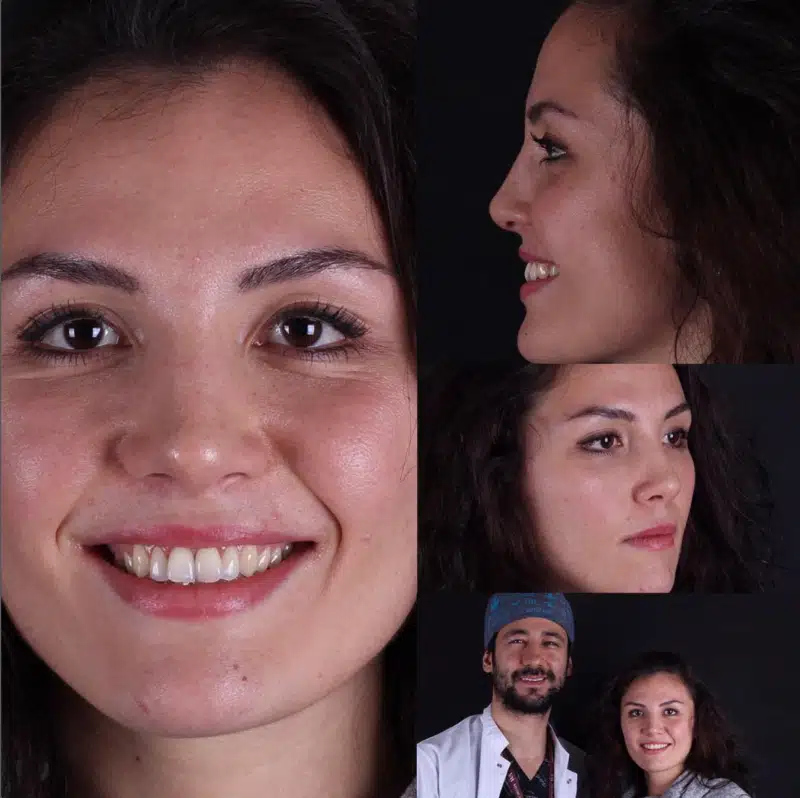 Suleyman Tas reviews – verified rhinoplasty patient review #358