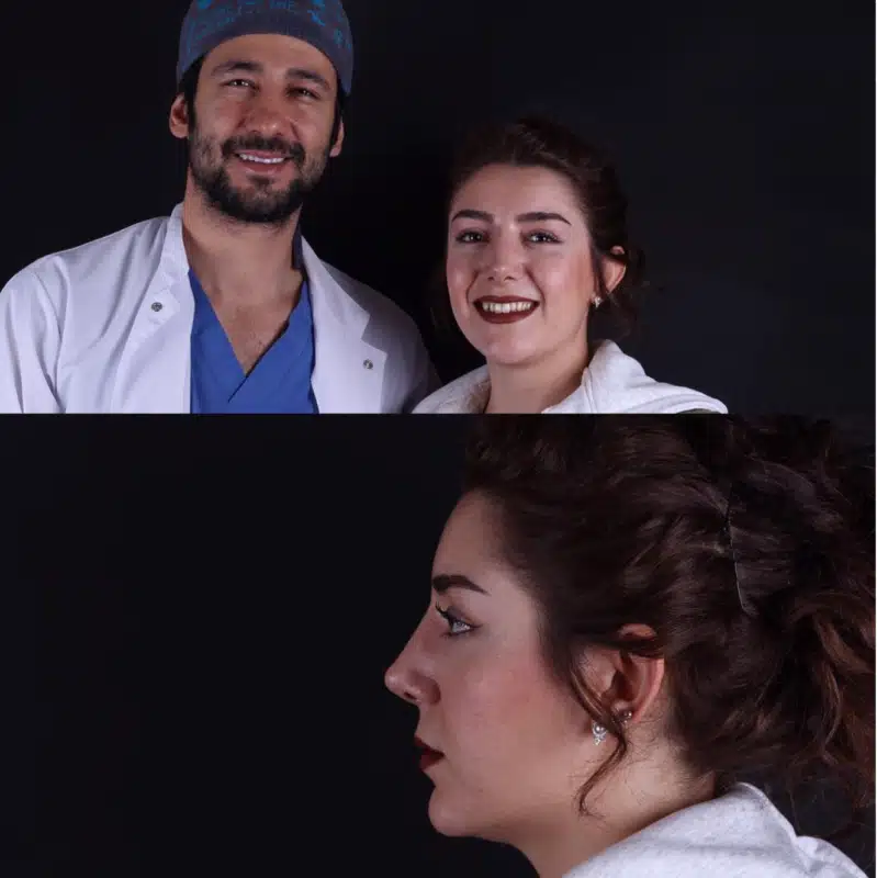 Suleyman Tas reviews – verified rhinoplasty patient review #344