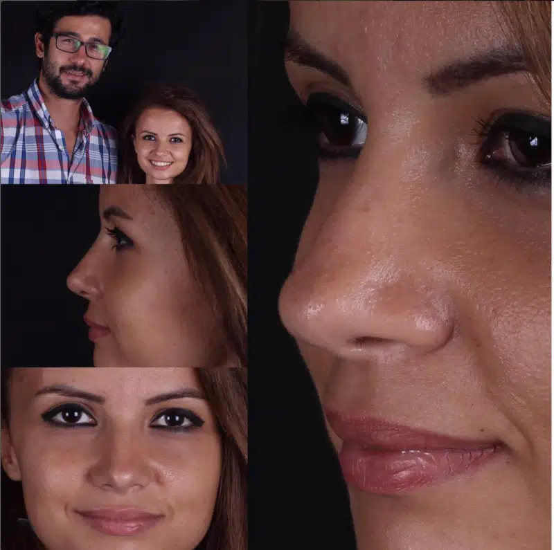Suleyman Tas reviews – verified rhinoplasty patient review #297